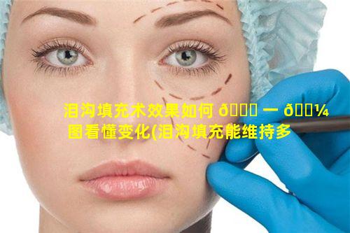 泪沟填充术效果如何 🍀 一 🌼 图看懂变化(泪沟填充能维持多久多少钱)